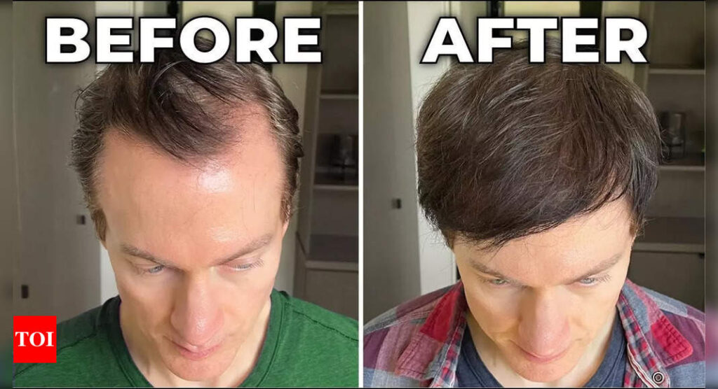 Millionaire Bryan Johnson reveals how he hacked genetic baldness and premature hair greying |