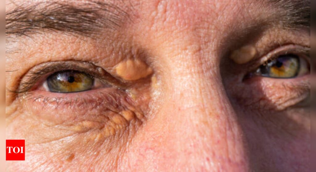 Xanthelasma: Are eyelid bumps a hidden danger? Know what it means for the heart health |