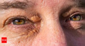 Xanthelasma: Are eyelid bumps a hidden danger? Know what it means for the heart health |